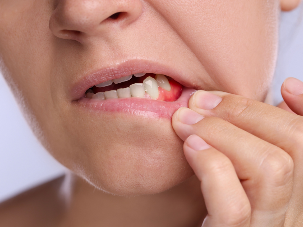Fístula dental