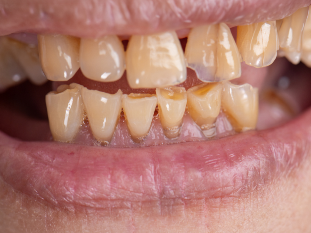Qué es la erosión dental