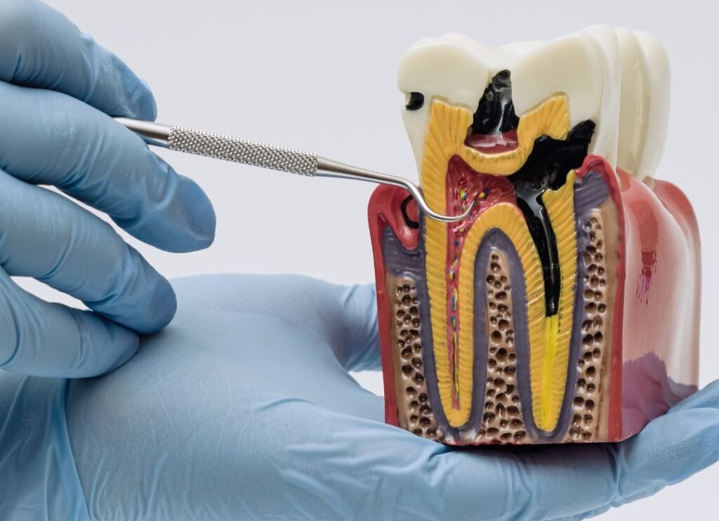 Caries radiculares